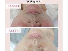 レクラ バイ ドクターエイチ(L'ECLAT by Doctor.H)/ララピール