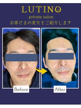 ルチノ(LUTINO)/ハリ・つや美肌50代10回