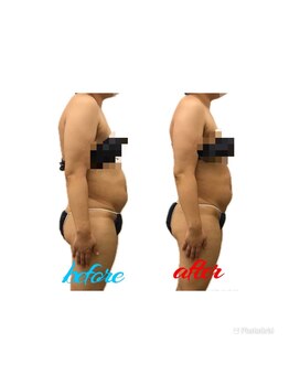 スマイルボディ つぼの森 吉野店(Smile body)/ラジオ波+オイルマッサージ