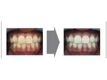 テラスアップ(Terrace UP)/【歯白く】セルフホワイトニング