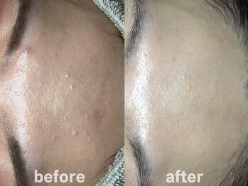 ホワイトアクア 鹿児島店(WHITE AQUA)/ハーブピーリング/鹿児島