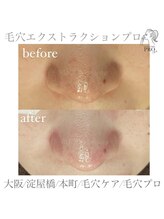 オーバイルッカ(O by RUCCA)/毛穴エクストラクションプロ