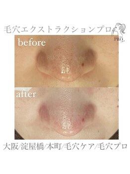 オーバイルッカ(O by RUCCA)/毛穴エクストラクションプロ