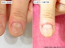 自爪育成・深爪・川崎