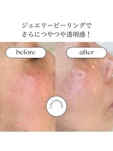 ユヌランコント 岐阜店(Une rencontre)/ジュエリーピーリング