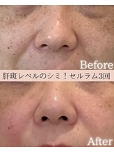 ココロ(COCORO)/お悩みのシミが　3回施術　