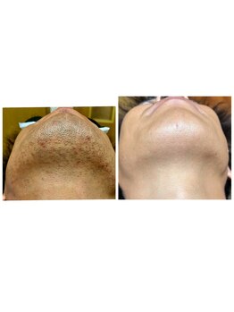 ブルー(blue)/ヒゲ脱毛