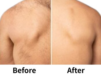 モンロー(MonroE+)/脱毛