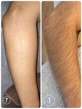 サロンエヌ 久留米店(Salon N)/腕脱毛before/after