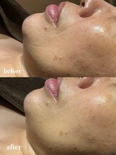 ナーズ(NAZ)/ハイブリット　光フェイシャル