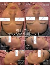ユフラ(Juhla)/切らない小顔リフトサーマル