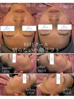 ユフラ(Juhla)/切らない小顔リフトサーマル