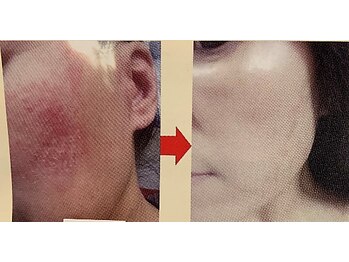 エスコート芦屋サロンの写真/長年の肌荒れ、肌トラブル、湿疹、夏のあせもでお困りの方！今年こそキレイになりましょう♪