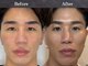 イロハ(IROHA)の写真/《美容男子/お肌をキレイにしたい男性はIROHAへ》毛開き・黒ずみ/凹凸肌/ニキビにお悩みの方に◎