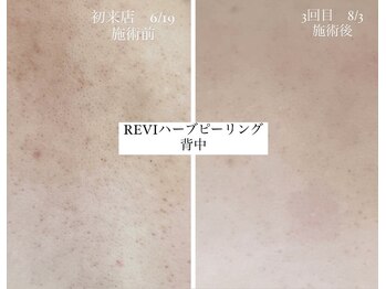 リフレ(Refre)/ブライダルにもハーブピーリング