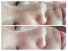 速攻小顔+毛穴【毛穴/角質/しみケア】水素ハイドロ毛穴＋小顔矯正+頭蓋骨調整