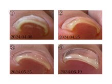 ルーシーズ アイラッシュアンドネイル 小倉店(Lucy's Eyelash&Nail)/巻き爪ケア