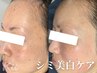 【エイジングケア/シミシワ改善】ハーブピーリング×小顔矯正 