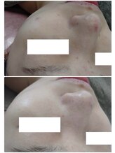 ビーユー(Be.you)/繰り返すニキビ