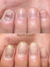 マリーロール 梅田店(Marie Laure)/深爪矯正/自爪育成/自爪風