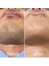 ハピネス 大阪梅田店(Happiness)/ヒゲBefore→After