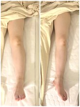 キラリ(Kirari)/高炭酸痩身マッサージ1回の施術