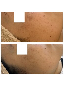 エクシア(ECXIA)/敏感な方にも優しいシミケア