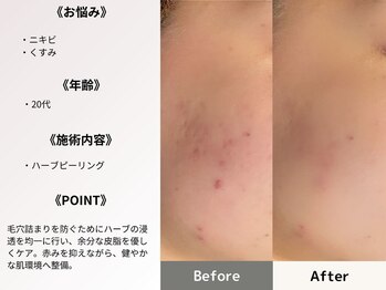 ルディラ 渋谷店/ハーブピーリング