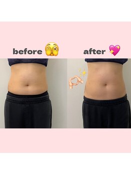 ナチュラル ユース(Natural youth)/お腹周りのbefore/after