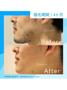 メンズクリア ららぽーと和泉店/【メンズクリア】お客様の施術例