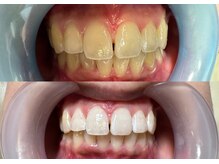 オーシャンハーブ(Ocean Harb)の雰囲気（ホワイトニング無加工ビフォーアフター◎）