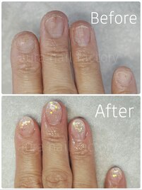 深爪矯正スカルプ(長さだし)赤羽