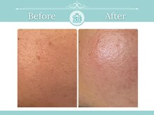 シミケアゼロ美人 表参道店(シミケアZERO美人)/【シミケア/シミゼロ症例】