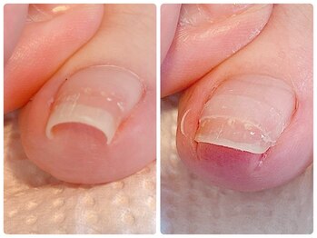 寺子屋ビューティーズ(寺子屋Beauty's)/巻き爪もここまで変わる？