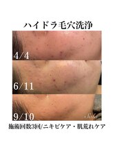 サラ/ハイドラ毛穴洗浄