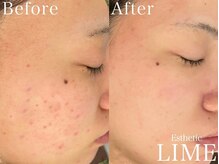 ベル 赤羽(Belle)/ハーブピーリング｜ニキビケア