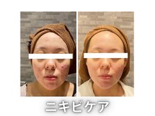 モルティープリマクラッセ 宇都宮東店(Molti Prima Classe)の雰囲気（ニキビケア◎期間3カ月◎よもぎ蒸し＆BTXパックでWアプローチ）