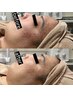 【ニキビケア/水分量UP/透明感】繰り返すトラブルに　肌質改善トリートメント
