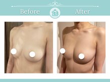 美人バスト 浄心店/バストアップ◇症例◇
