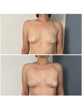 モア(moa)/産後ママバスト