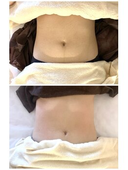 キラリ(Kirari)/高炭酸痩身マッサージ1回の施術