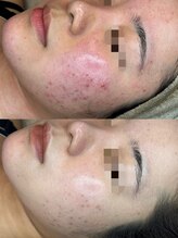 フルール ニコ(Fleur Nico)/3回のBeforeAfter