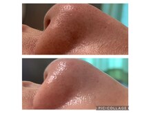 黒ずみ撃退！毛穴ケア！長年の悩みもさっぱり綺麗に◎