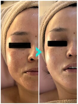 ミルキー(Milky)/喰いしばりのお顔もスッキリ