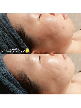 マイフェアレディ 今池(MyFairLady)/アゴ下ポニョ撃退★レモンボトル