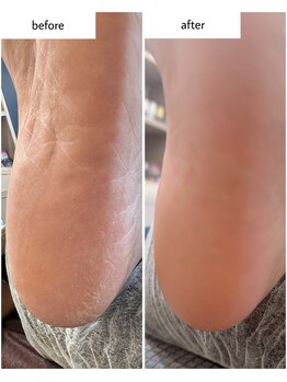 ケアプラス(care plus)/足裏角質ケア