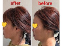 サロン モモ(Salon momo)の雰囲気（小顔リフト befor→after　ほうれい線　くすみ解消）