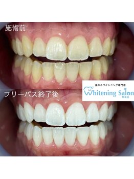 ホワイトニングサロン 熊本店/楽ちんセルフホワイトニング