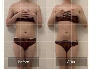 フルール(fleur)/キャビテーション