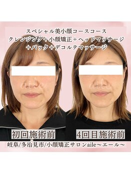 エール(aile)/エラハリでお悩みの方多数ご来店